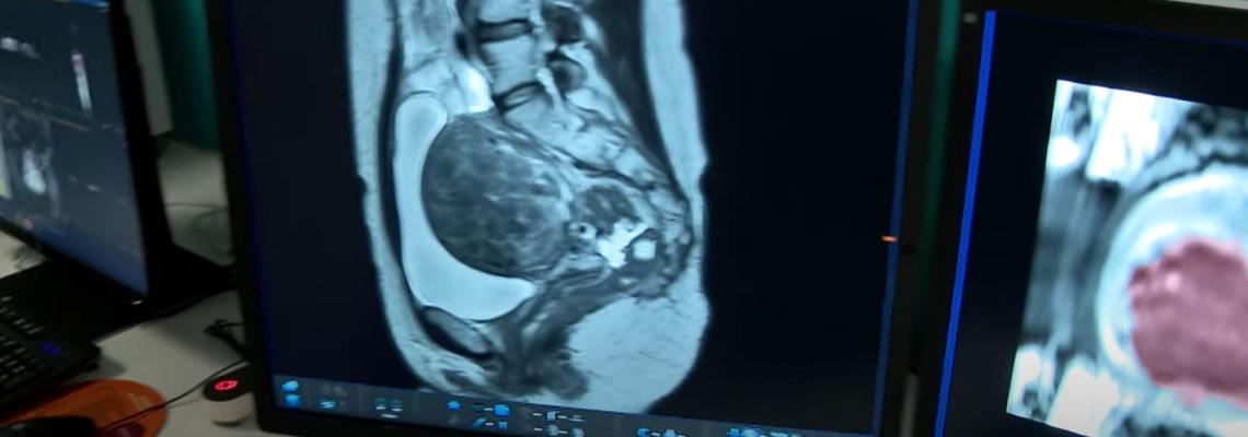 CHPG: Nuovo sistema di trattamento dei fibromi uterini